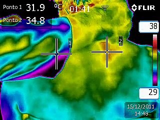 Neurofuctional Thermoguided Acupuncture _ Acupuntura Neurofuncional Termoguiada