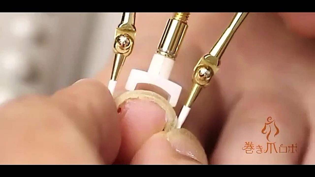 Batık Tırnak Nasıl Düzeltilir