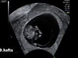 9 Haftalık Gebelik Bebek Ultrason Görüntüsü