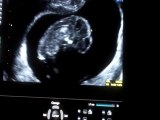 10 Haftalık Gebelik Bebek Ultrason Görüntüsü