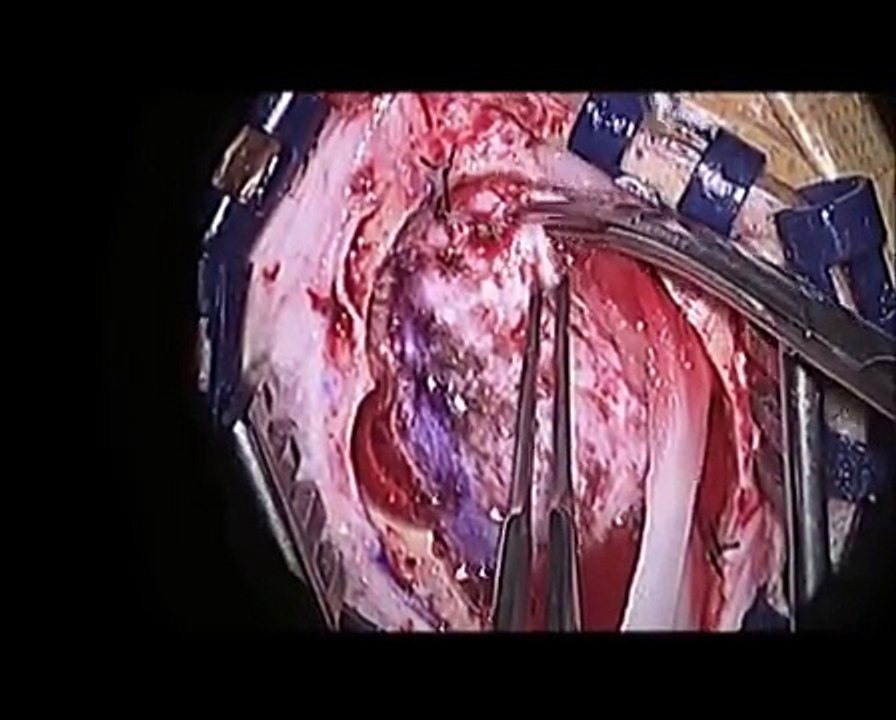 Brain Surgery : Removal of Occipital Meningioma