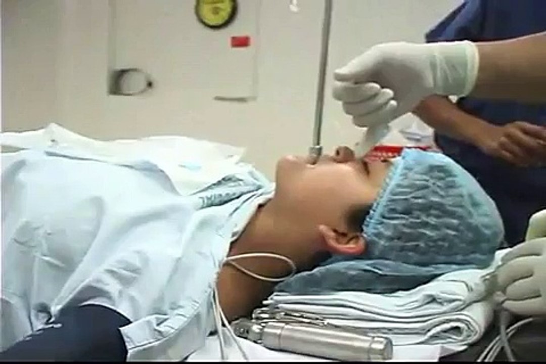 iNTUBACION ENDOTRAQUEAL 4-6