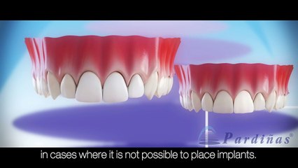 Dental Implants Vs. Dental bridge - Comparision ©