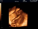 16 Haftalık Gebelik Bebek Ultrason Görüntüsü
