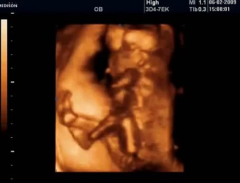 17 Haftalık Gebelik Bebek Ultrason Görüntüsü