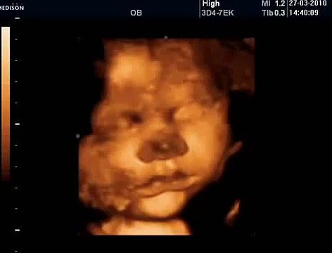 36 Haftalık Gebelik Bebek Ultrason Görüntüsü