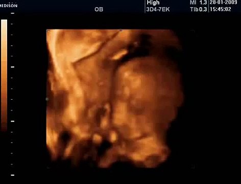 24 Haftalık Gebelik Bebek Ultrason Görüntüsü