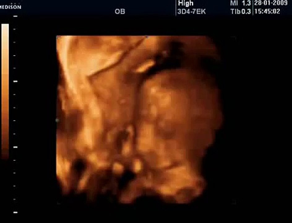 24 Haftalık Gebelik Bebek Ultrason Görüntüsü
