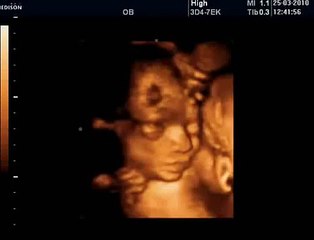 26 Haftalık Gebelik Bebek Ultrason Görüntüsü