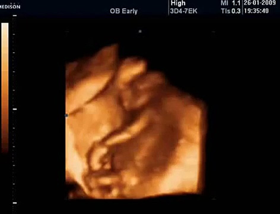 30 Haftalık Gebelik Bebek Ultrason Görüntüsü