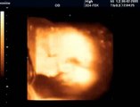 33 Haftalık Gebelik Bebek Ultrason Görüntüsü