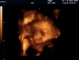 34 Haftalık Gebelik Bebek Ultrason Görüntüsü