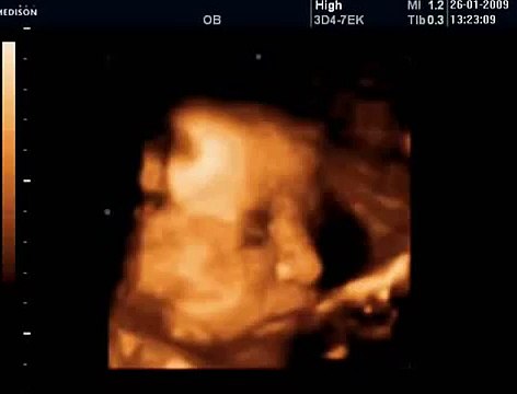 38 Haftalık Gebelik Bebek Ultrason Görüntüsü