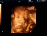 39 Haftalık Gebelik Bebek Ultrason Görüntüsü