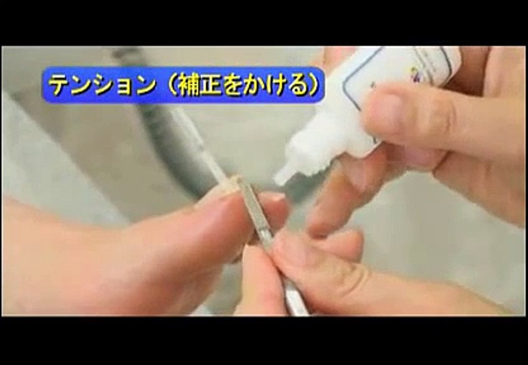 巻き爪補正のペディグラス（巻爪／陥入爪）