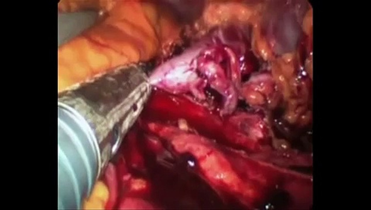 Kidney Tumor Removal Through Belly Button