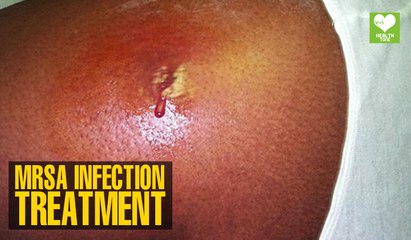 MRSA Infection Treatment | Health Tips | Education