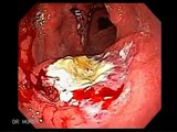 Endoscopy of a Gastric MALT lymphoma