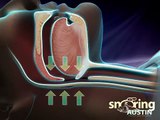 What Causes Snoring and Obstructive Sleep Apnea?