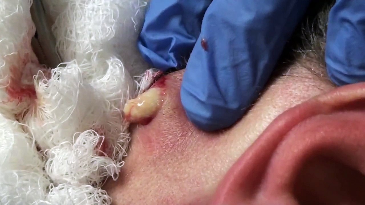 Justin's junk cyst on neck