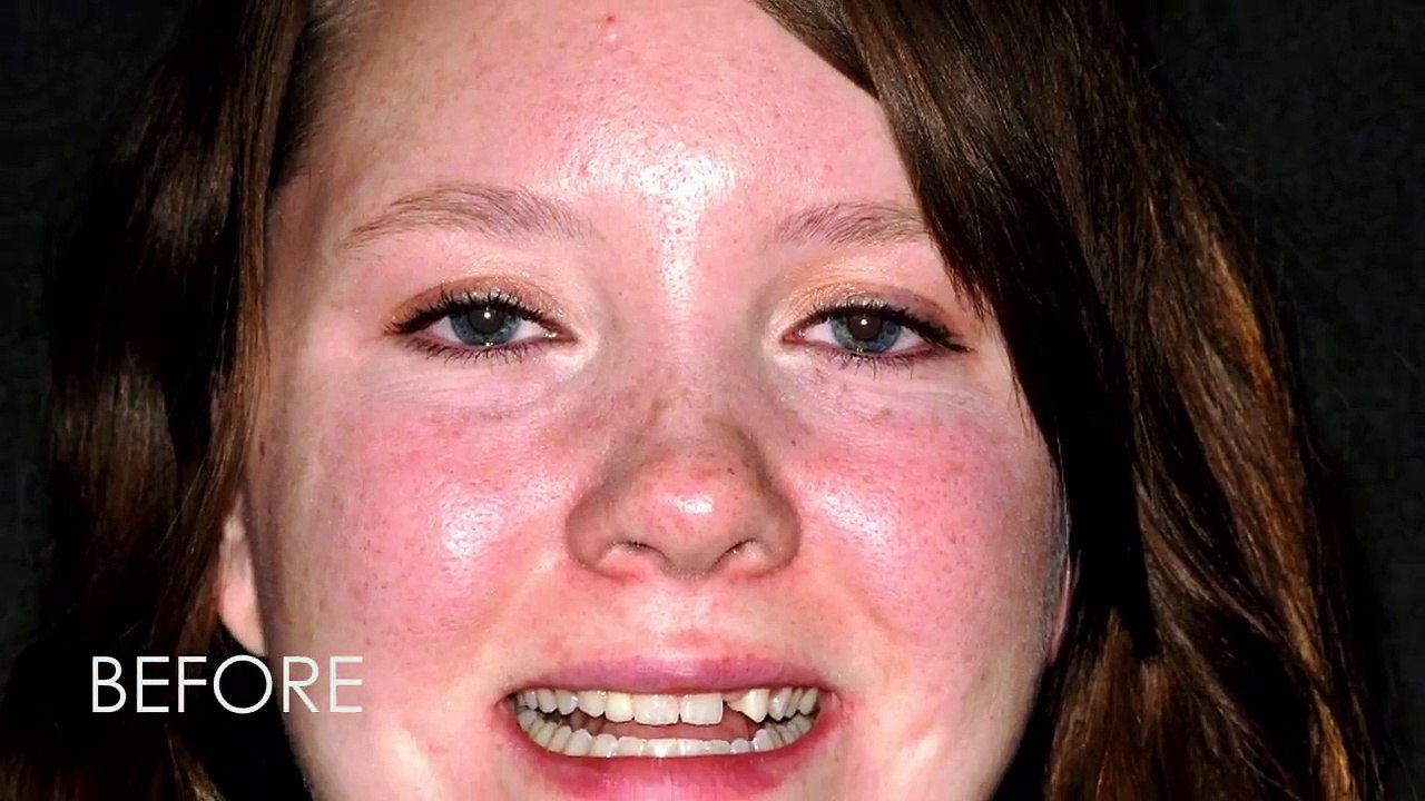 Cosmetic Dentistry Patient - Sugar Land - Advanced Dentistry - Dr. Varghese John