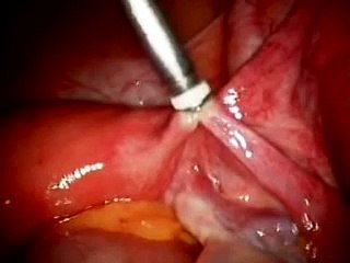 Female Tubal Sterilization - Fallope ring