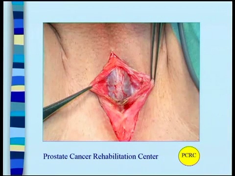 Continence and Erectile Rehabilitation Following Prostate Cancer Surgery by Dr Phillip Katelaris