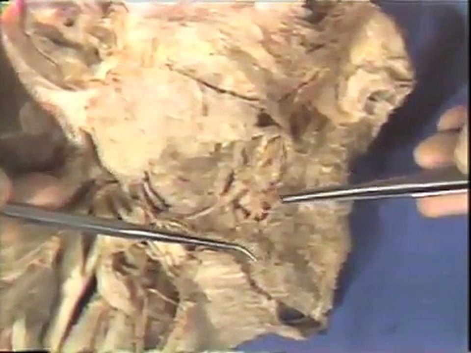 Dissection: Lateral Aspect of Face; Facial Nerve