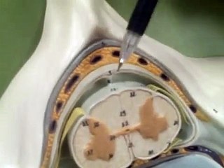 meninges in spinal cord