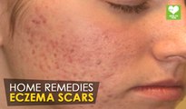 Eczema Scars - Home Remedies | Health Tone Tips