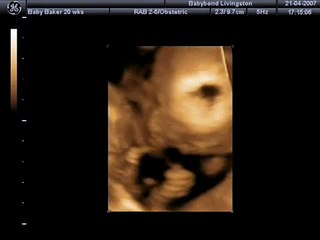 3D/4D Baby Scan at 20 weeks