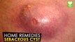 Sebaceous Cyst - Home Remedies | Health Tone Tips