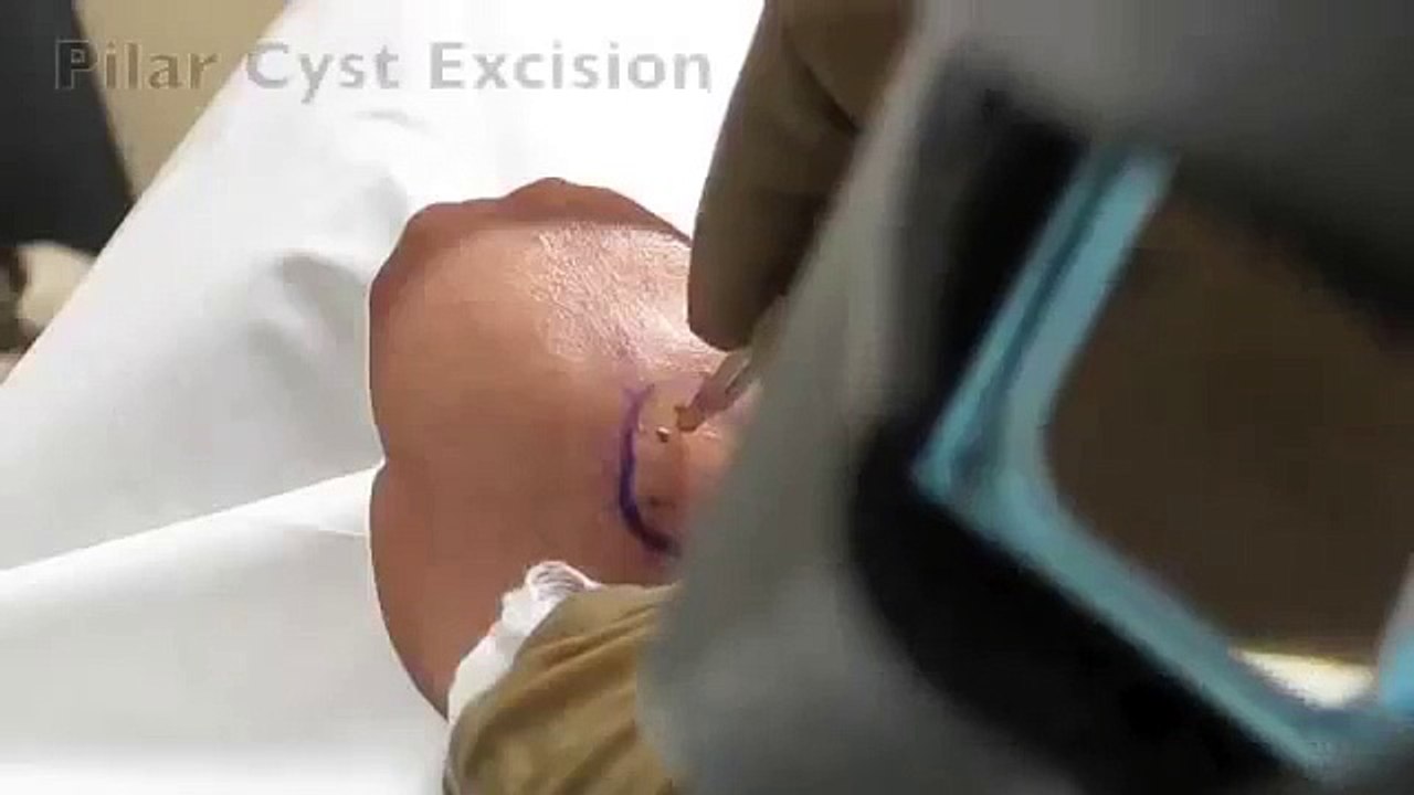 Pilar Cyst Excision at Las Vegas Dermatology