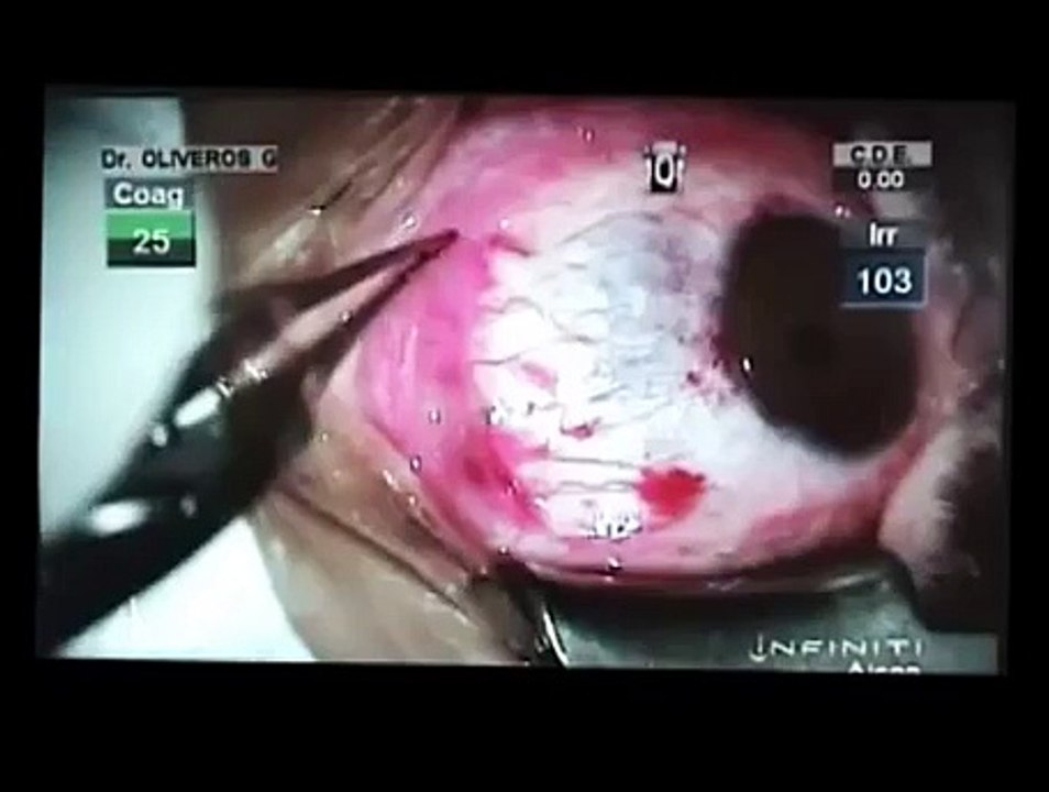 Blanqueamiento Ocular y de ojos
