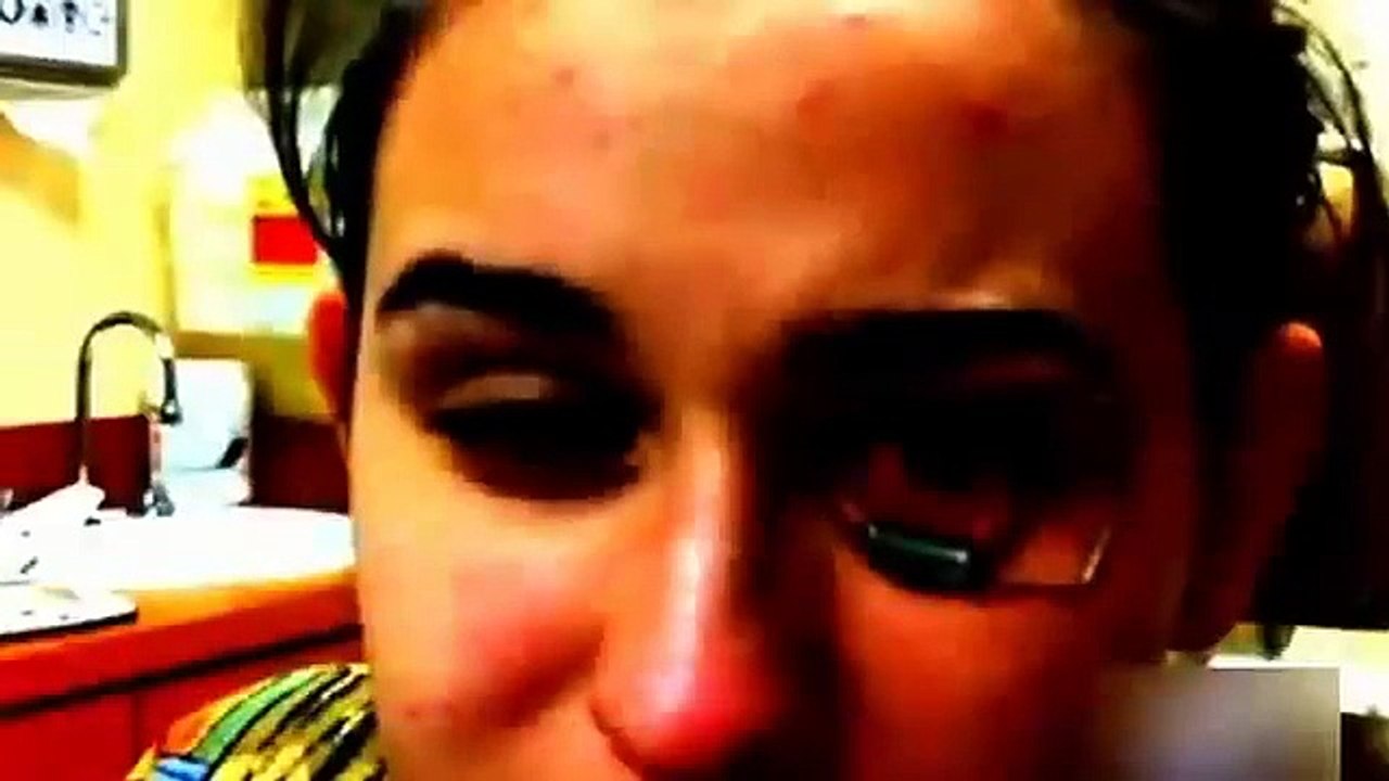 Contact lenses gone wrong_ parasite invades teenagers' eyeball video Dailymotion