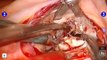 Robotically Assisted Mitral Valve Repair - Mitral Valve Endocardidits - From Cleveland Clinic