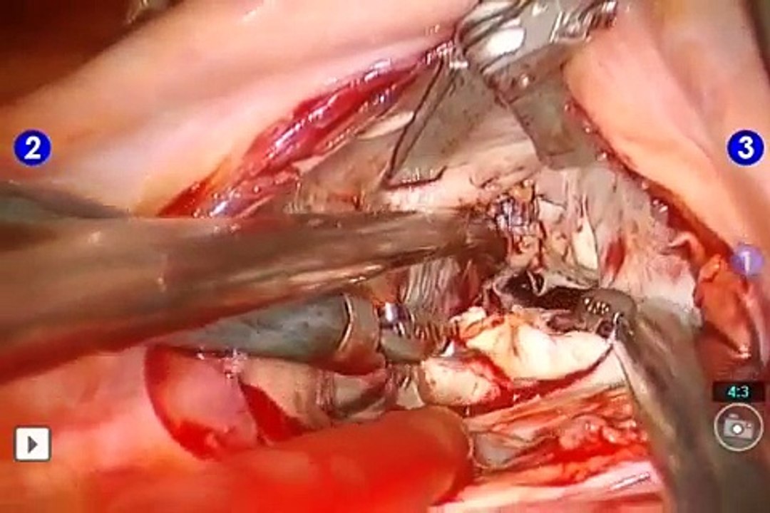 Robotically Assisted Mitral Valve Repair - Mitral Valve Endocardidits - From Cleveland Clinic