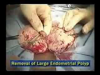 Osada Procedure for Massive Adenomyosis: Preserving Uterus