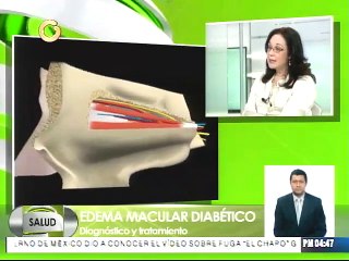 ¿Cuál es el diagnostico para determinar el edema macular?