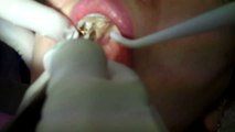 Top Google Tooth Extraction Dentist San Jose