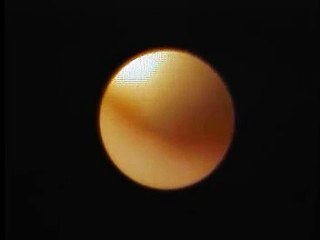 イヤー・スコープを利用した耳掃除の様子です。