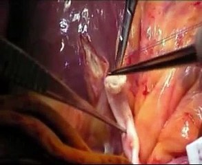 Heart bypass: microvascular surgery
