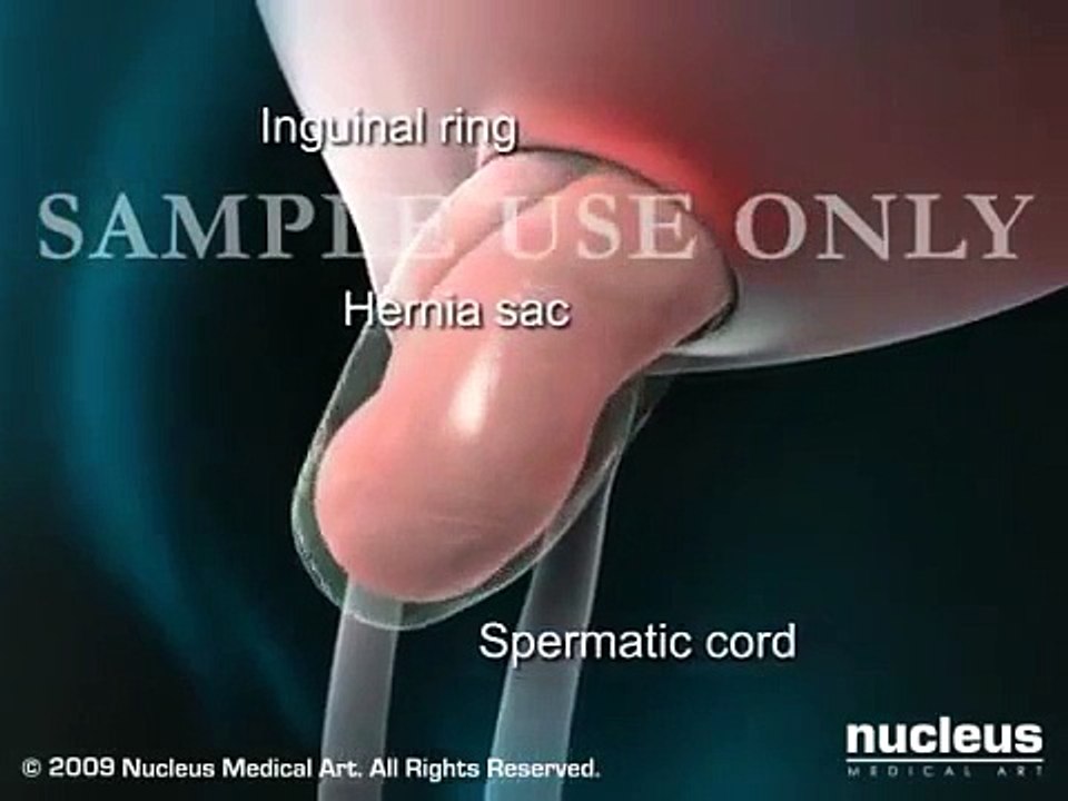 Inguinal Hernia   Medical Animation