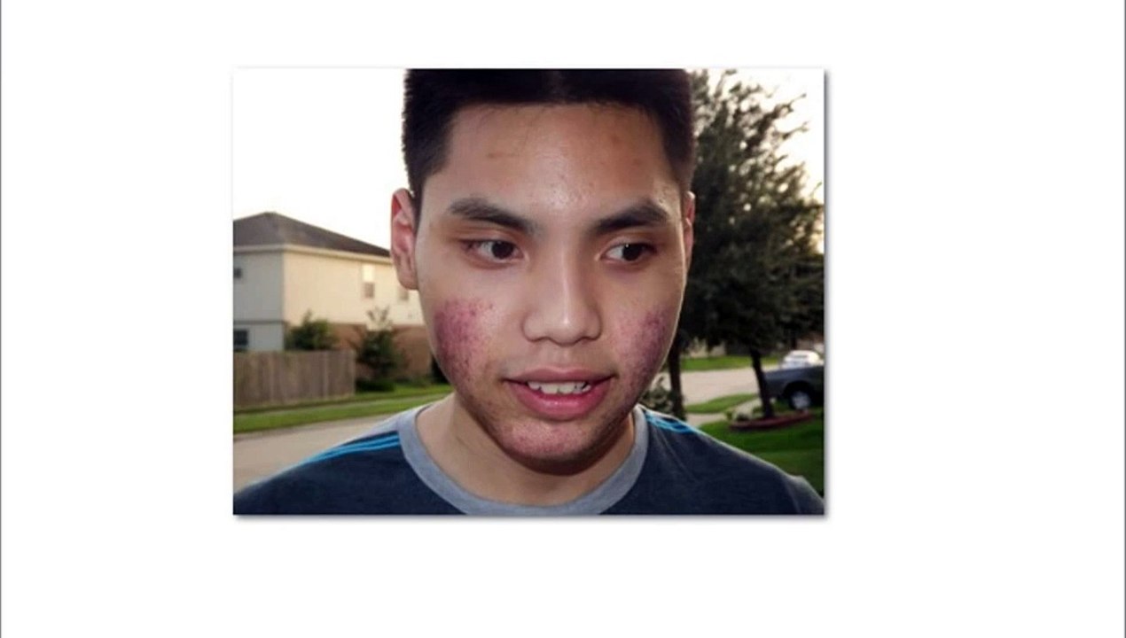 Acne No More Review, is it a scam