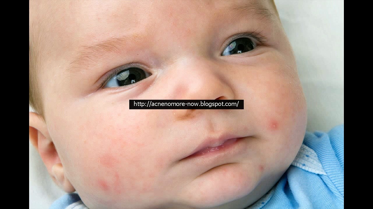 Acne Treatment - Acne No More