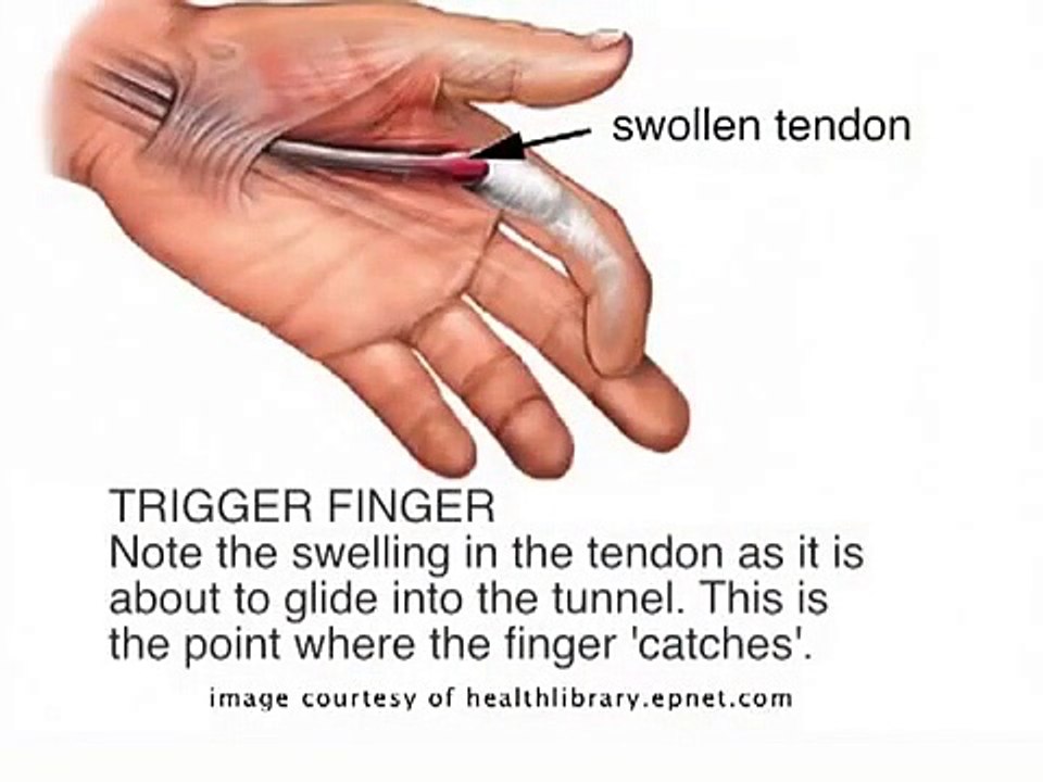 Trigger Finger