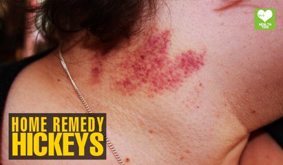 How To Treat Hickeys | Health Tips | Educational Video