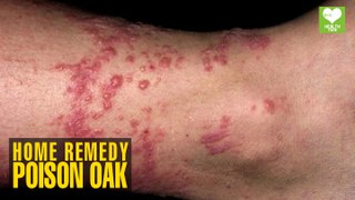 Home Remedies to Get Rid of Poison Oak Health Tips Educational Video