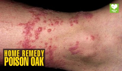 Home Remedies to Get Rid of Poison Oak Health Tips Educational Video
