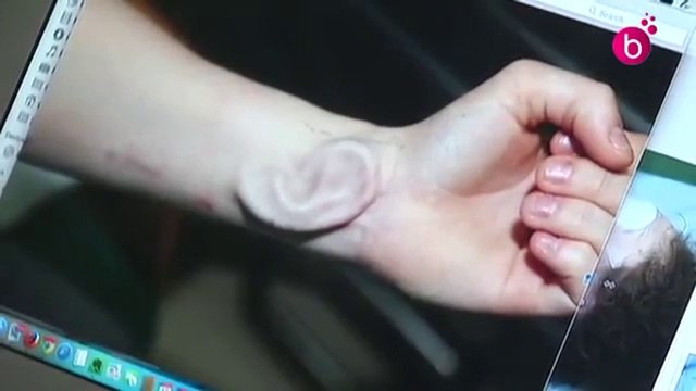 Doctors implant an ear to a girl, ear created in her own body - so impressive surgery